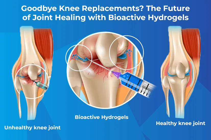 Goodbye Knee Replacements? The Future of Joint Healing with Bioactive Hydrogels Goodbye Knee Replacements? The Future of Joint Healing with Bioactive Hydrogels