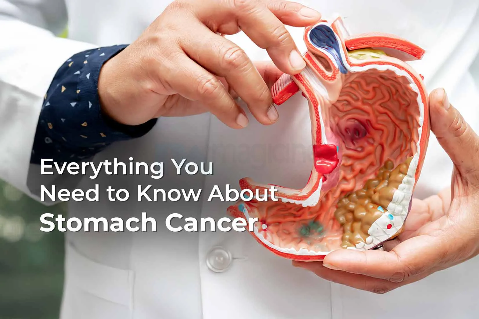 Understanding Stomach Cancer: Causes, Symptoms, Types, Diagnosis & Treatments Understanding Stomach Cancer: Causes, Symptoms, Types, Diagnosis & Treatments