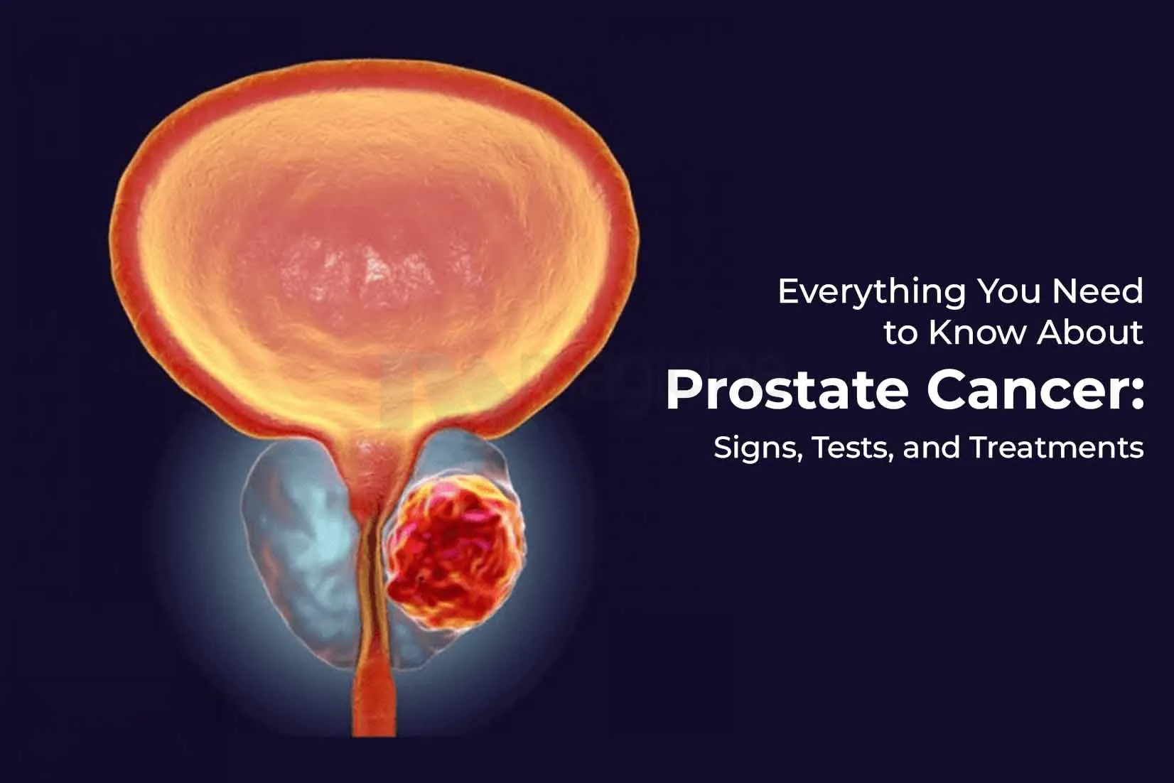 Everything You Need to Know About Prostate Cancer: Signs, Tests, and Treatments Everything You Need to Know About Prostate Cancer: Signs, Tests, and Treatments