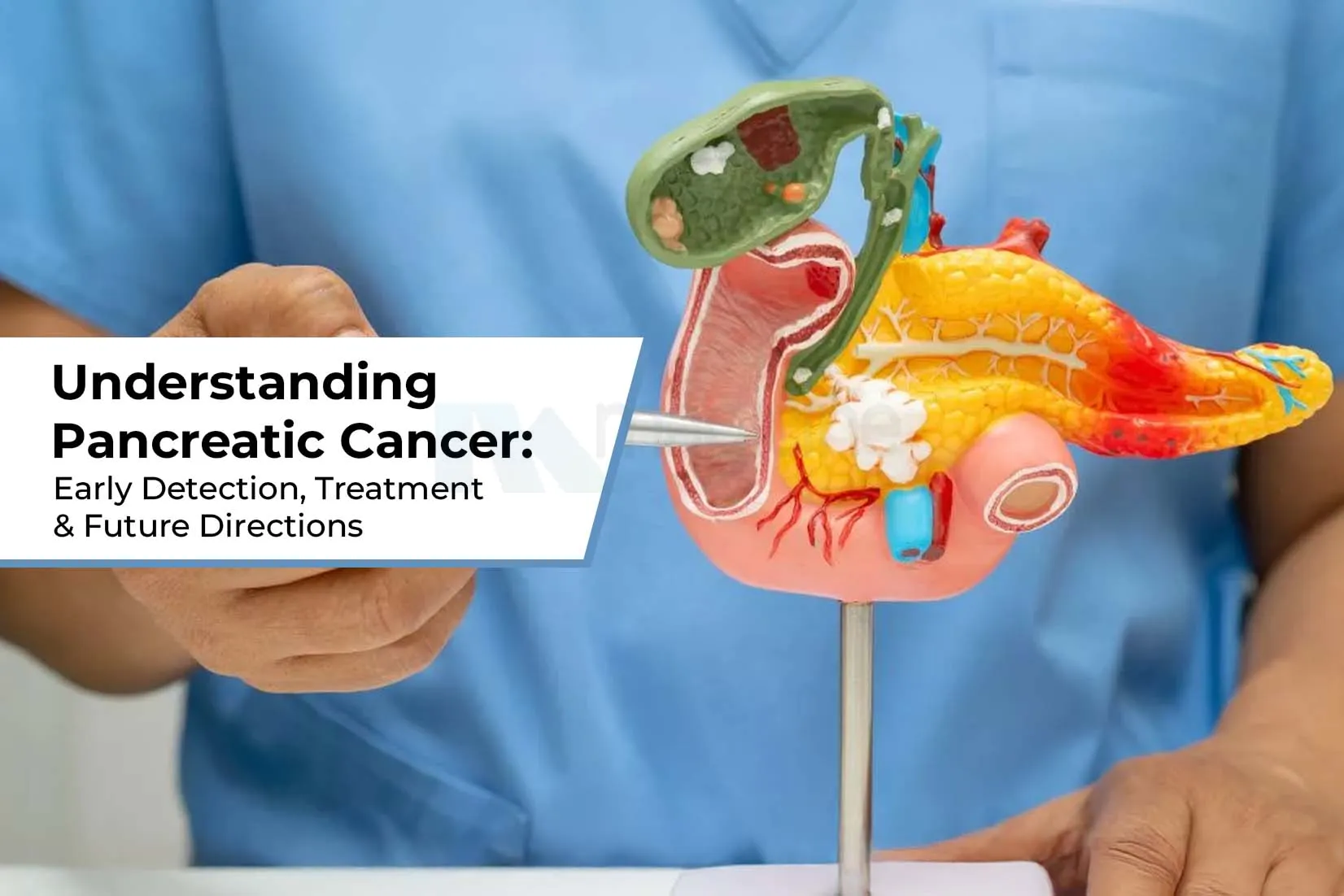 Understanding Pancreatic Cancer: Early Detection, Treatment & Future Directions Understanding Pancreatic Cancer: Early Detection, Treatment & Future Directions
